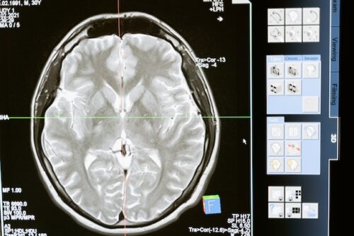 brain injuries scan
